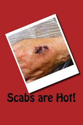 Book cover for Scabs are Hot!