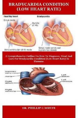 Cover of Bradycardia Condition (Low Heart Rate)