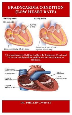 Book cover for Bradycardia Condition (Low Heart Rate)