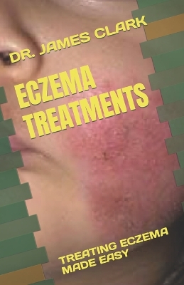 Book cover for Eczema Treatments