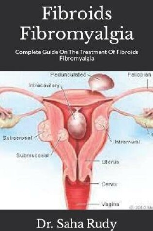 Cover of Fibroids Fibromyalgia