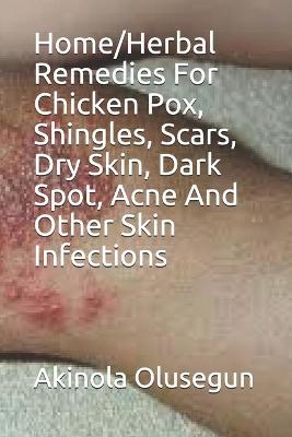 Book cover for Home/Herbal Remedies For Chicken Pox, Shingles, Scars, Dry Skin, Dark Spot, Acne And Other Skin Infections