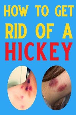 Book cover for How to Get Rid of a Hickey