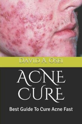 Cover of Acne Cure