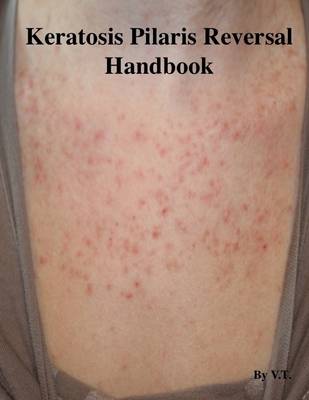 Book cover for Keratosis Pilaris Reversal Handbook