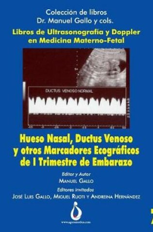 Cover of Hueso Nasal, Ductus Venoso Y Otros Marcadores Ecogr ficos de I Trimestre de Embarazo