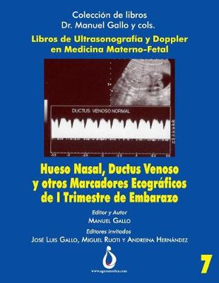 Book cover for Hueso Nasal, Ductus Venoso Y Otros Marcadores Ecogr ficos de I Trimestre de Embarazo