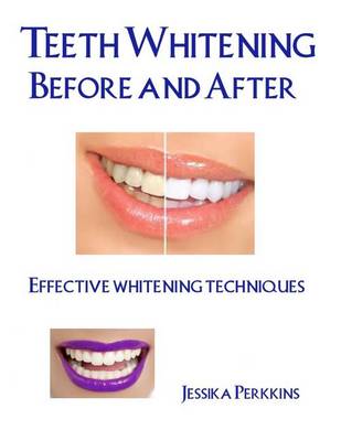 Cover of Teeth Whitening Before and After