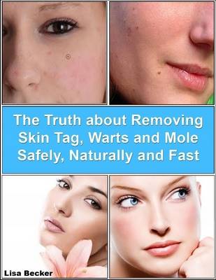 Book cover for The Truth About Removing Skin Tag, Warts and Mole Safely, Naturally and Fast