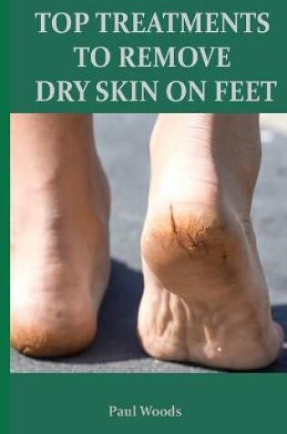 Cover of Top Treatments to Remove Dry Skin on Feet
