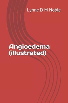 Book cover for Angioedema (illustrated)