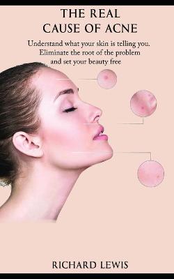 Book cover for The Real Cause Of Acne