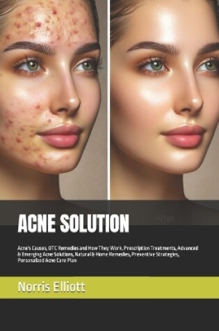 Cover of Acne Solution