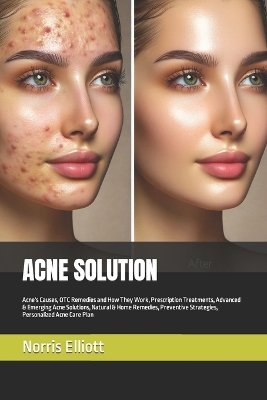 Book cover for Acne Solution