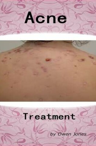 Cover of Acne Treatment