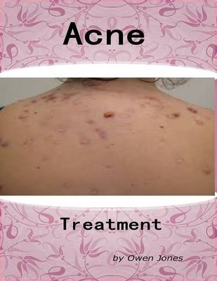 Book cover for Acne Treatment