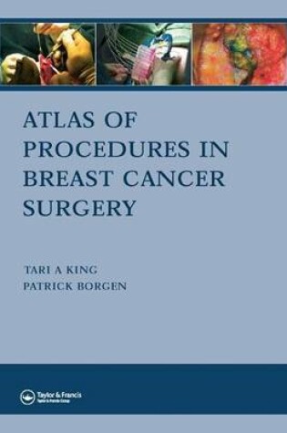 Cover of Atlas of Procedures in Breast Cancer Surgery