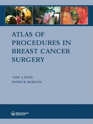 Book cover for Atlas of Procedures in Breast Cancer Surgery