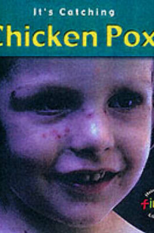 Cover of It's Catching: Chicken Pox