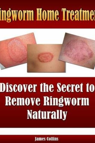 Cover of Ringworm Home Treatment: Discover the Secret to Remove Ringworm Naturally