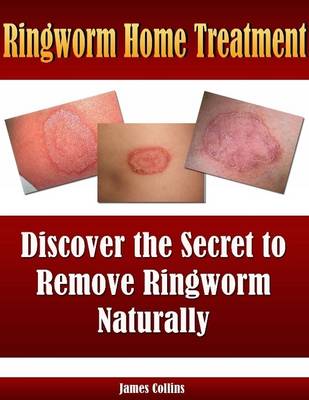 Book cover for Ringworm Home Treatment: Discover the Secret to Remove Ringworm Naturally