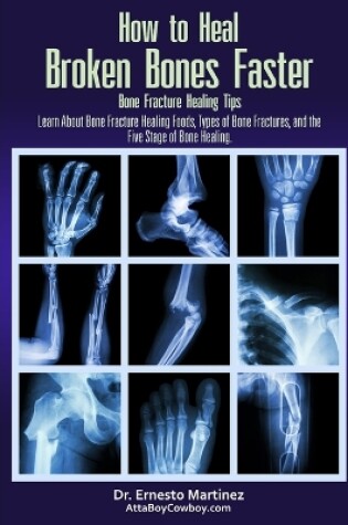 Cover of How to Heal Broken Bones Faster. Bone Fracture Healing Tips