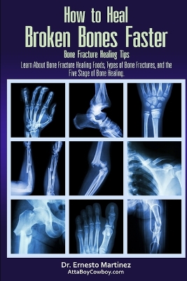 Cover of How to Heal Broken Bones Faster. Bone Fracture Healing Tips