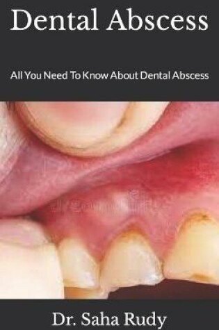 Cover of Dental Abscess