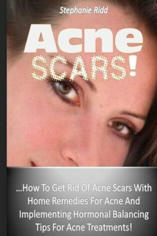 Cover of Acne Scars!