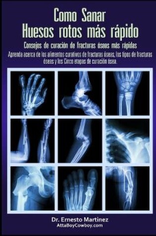 Cover of Como curar huesos rotos más rápido. Consejos para curar fracturas de huesos