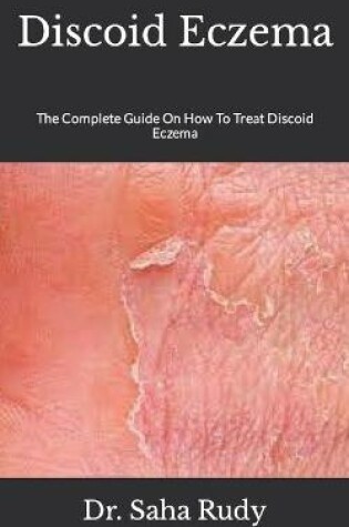 Cover of Discoid Eczema