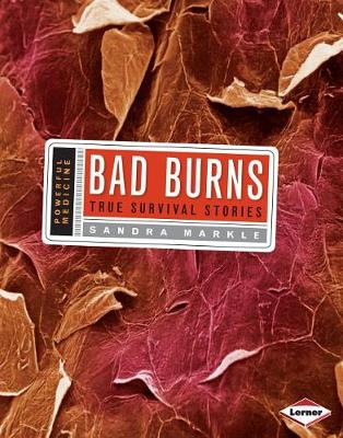 Book cover for Bad Burns