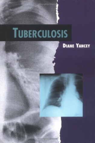 Cover of Tuberculosis