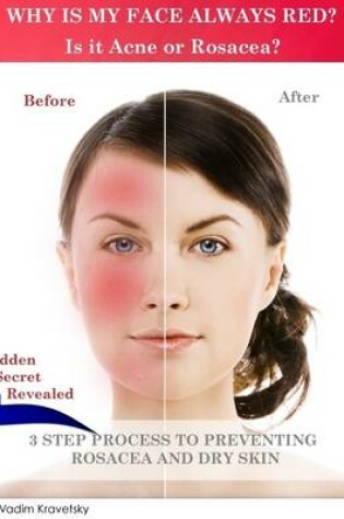 Cover of Why Is My Face Always Red? Is It Acne or Rosacea?: Hidden Secret Revealed 3 Step Process to Preventing Rosacea and Dry Skin