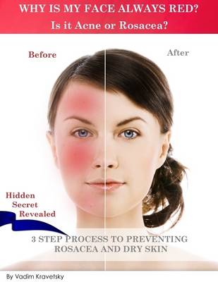 Book cover for Why Is My Face Always Red? Is It Acne or Rosacea?: Hidden Secret Revealed 3 Step Process to Preventing Rosacea and Dry Skin