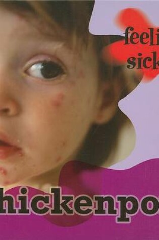 Cover of Chickenpox