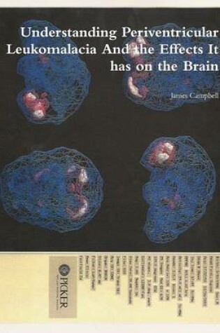 Cover of Understanding Periventricular Leukomalacia And the Effects It has on the Brain