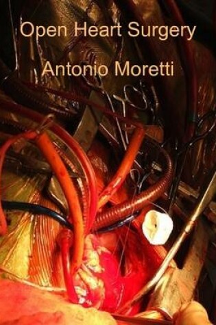 Cover of Open Heart Surgery