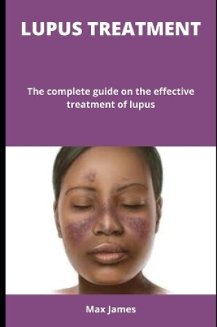 Cover of Lupus Treatment