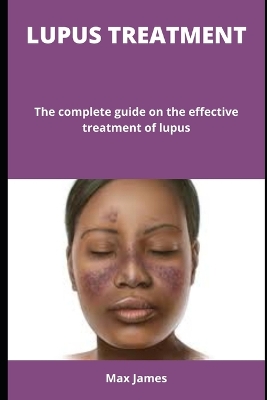 Book cover for Lupus Treatment