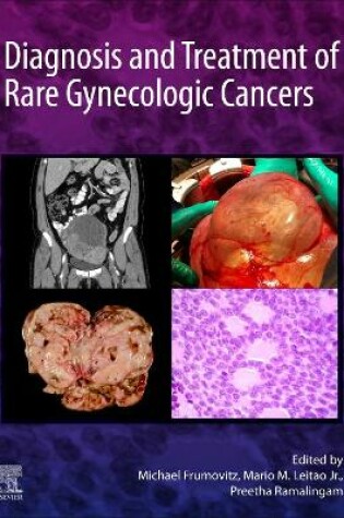 Cover of Diagnosis and Treatment of Rare Gynecologic Cancers - E-Book