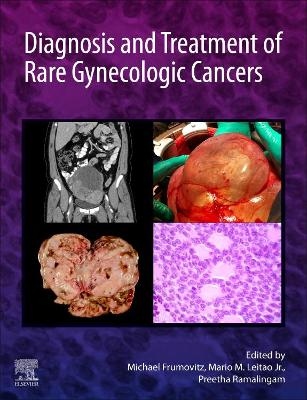 Book cover for Diagnosis and Treatment of Rare Gynecologic Cancers - E-Book