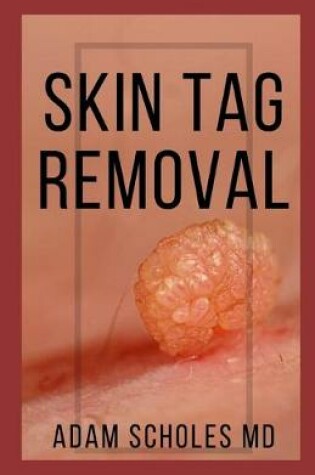 Cover of Skin Tag Removal