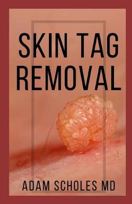 Book cover for Skin Tag Removal