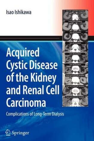 Cover of Acquired Cystic Disease of the Kidney and Renal Cell Carcinoma