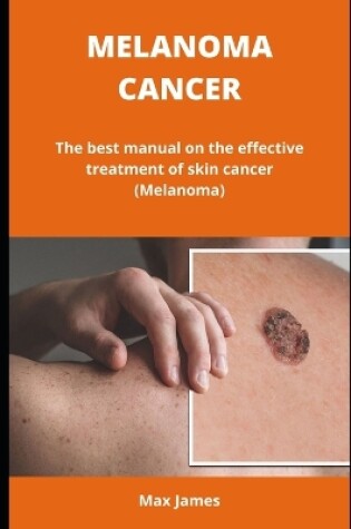 Cover of Melanoma Cancer