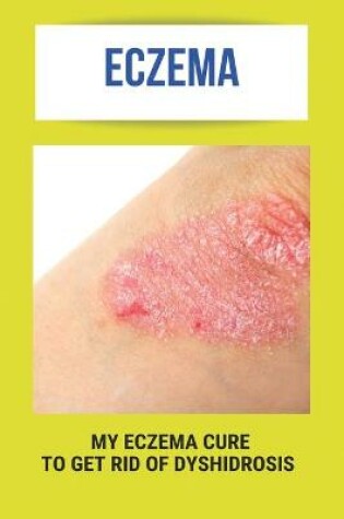 Cover of Eczema