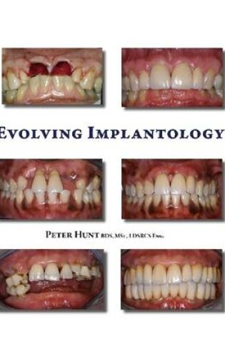 Cover of Evolving Implantology