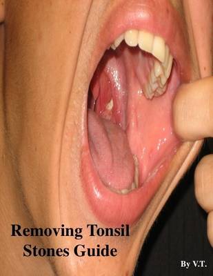 Book cover for Removing Tonsil Stones Guide