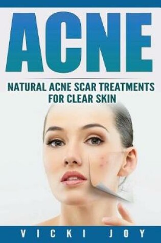 Cover of Acne